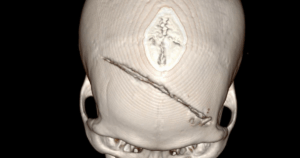 Bang Ct Scans Cac Bac Si Cho Biet Nan Nhan Bi Lun So Tran Hai Ben Dap Xuat Huyet Nao Thuy Tran Phai