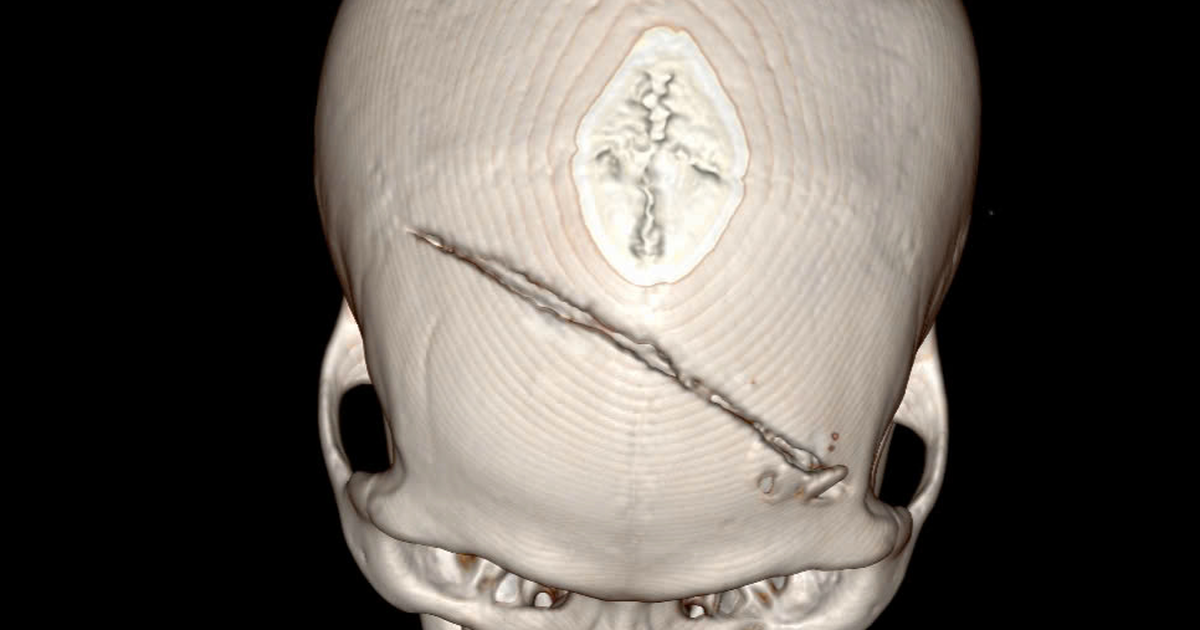 Bang Ct Scans Cac Bac Si Cho Biet Nan Nhan Bi Lun So Tran Hai Ben Dap Xuat Huyet Nao Thuy Tran Phai