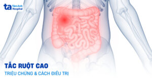 bi tac ruot cao