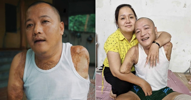 Mat 2 Tay 1 Chan Sau Tai Nan Nguoi Dan Ong Tim Lai Cuoc Doi Nho Tinh Yeu Cua Vo 2228