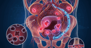 N Liet La Loai Ung Thu Pho Bien Nhat O Nam Gioi Anh Voi Khoang 55 Ngan Ca Moi Moi Nam Anh Minh Hoa A