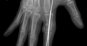 Ngon Tay Dut Roi 1765245779543706949466 270 0 673 645 Crop 176524579009885443875