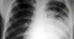 Viem Phoi Bm 1763040328758238803802 24 0 372 556 Crop 1763040339054603642966